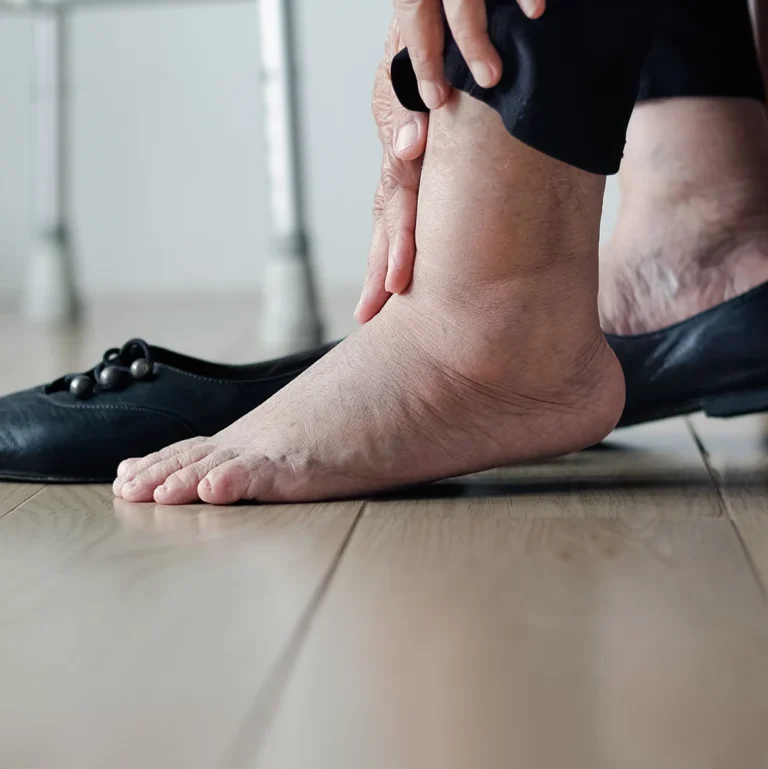 Sichtbar geschwollener Fuß im Knöchel- und Unterschenkelbereich