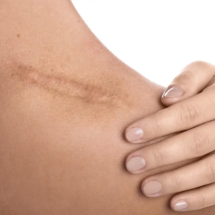 Narbe im Schulterbereich