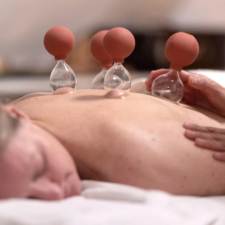 Schröpfen mit 4 Schröpfgläsern am Rücken